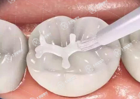 根管治療過程中可以刷牙嗎