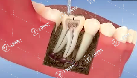 牙髓炎根管治療痛嗎