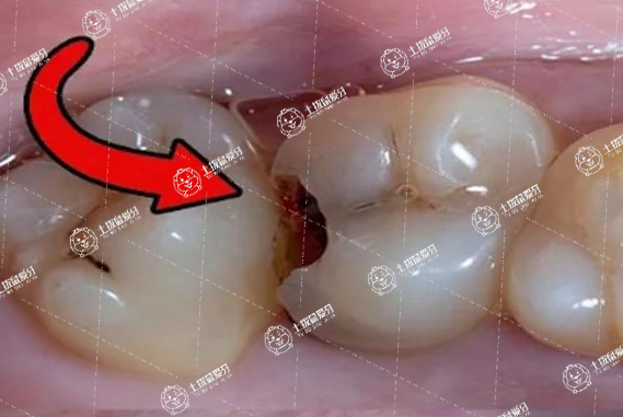 牙髓炎根管治療痛嗎