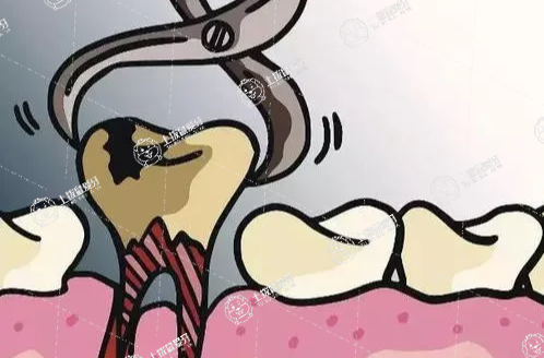拔牙多少錢一顆