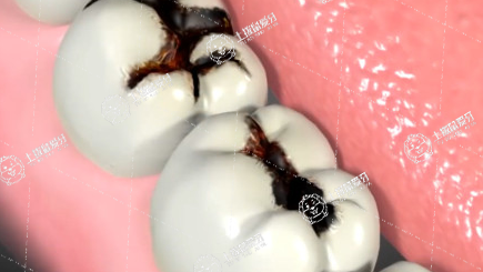 小孩拔牙注意事項(xiàng)與禁忌癥