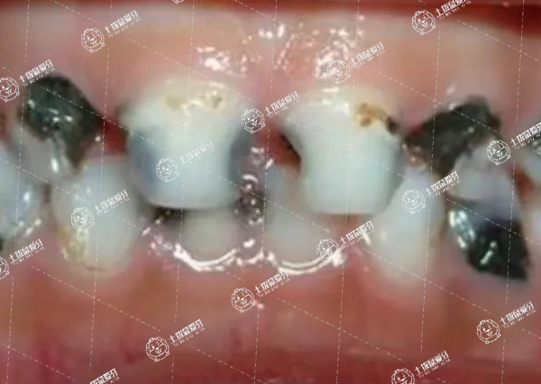 小孩拔牙注意事項(xiàng)與禁忌癥