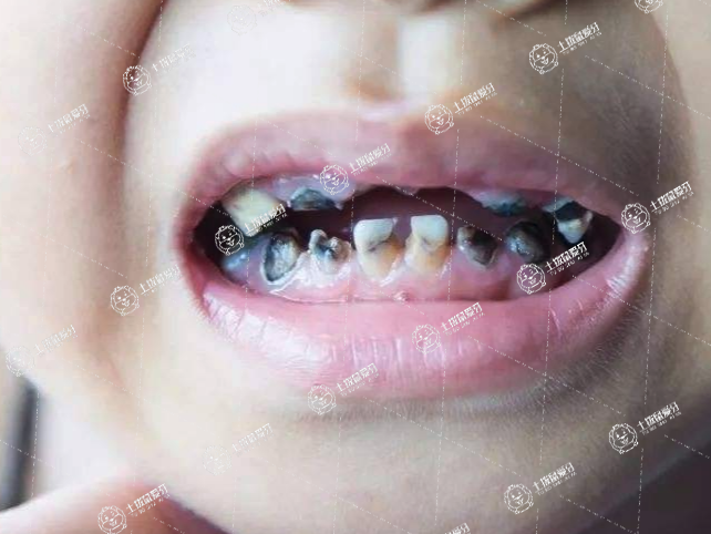 拔牙后多久可以鑲牙