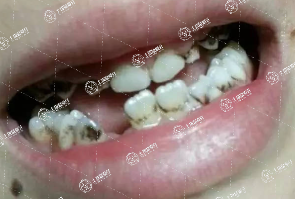 拔牙后吃什么藥