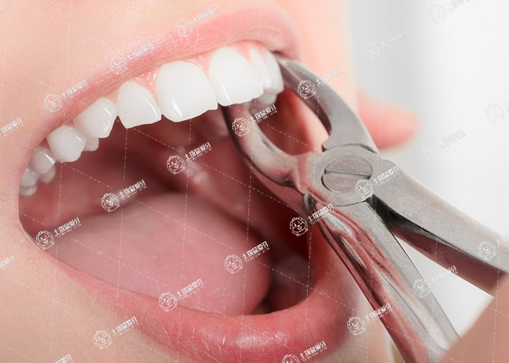 拔牙后多久可以鑲牙