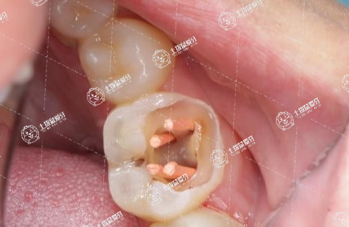 缺牙不補有什么危害