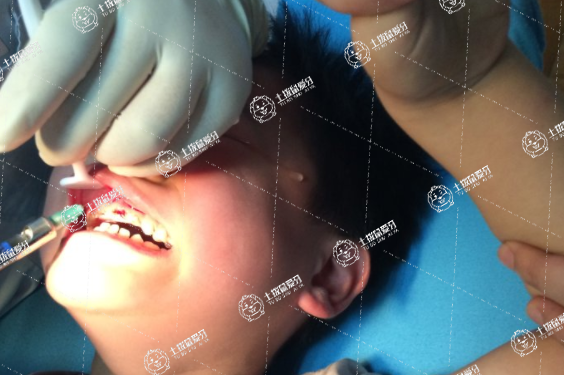 兒童補牙的方法