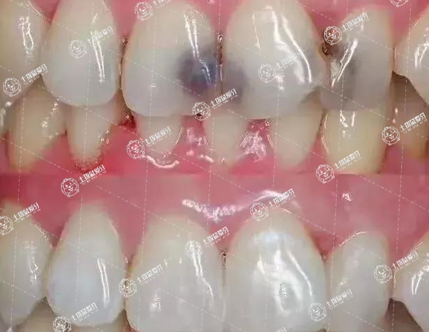 兒童補牙的方法