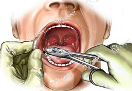 拔牙多久能止血