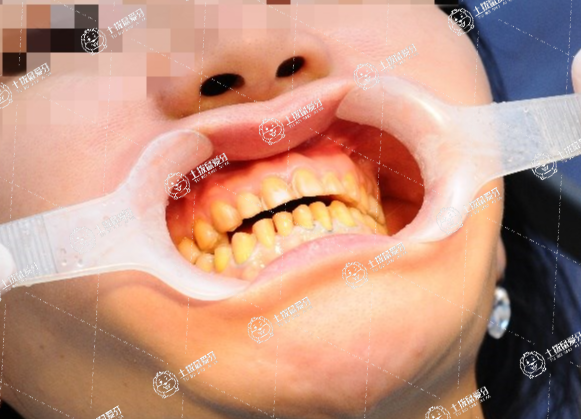 牙齒貼面好嘛