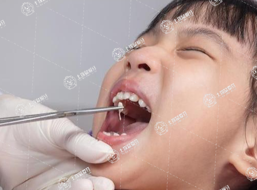 補牙需要多少錢補一顆