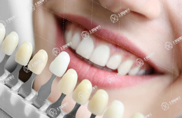 烤瓷牙一顆多少錢