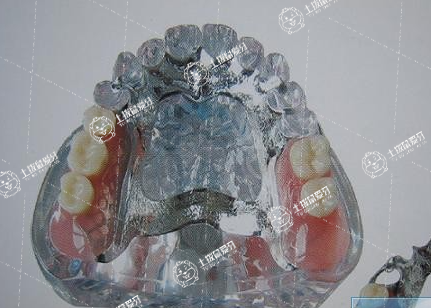 烤瓷牙的優(yōu)缺點(diǎn)