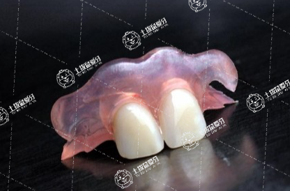 全瓷牙可以刷醫(yī)保嗎