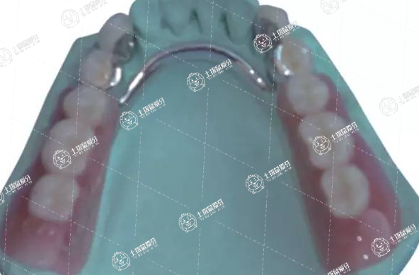 全瓷牙貴不貴