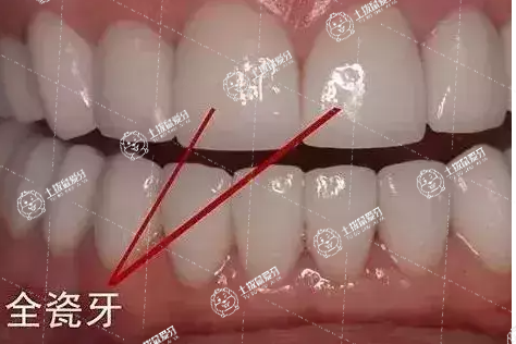 全瓷牙的優(yōu)缺點(diǎn)