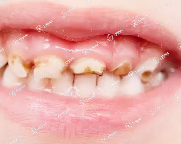 全瓷牙效果怎么樣