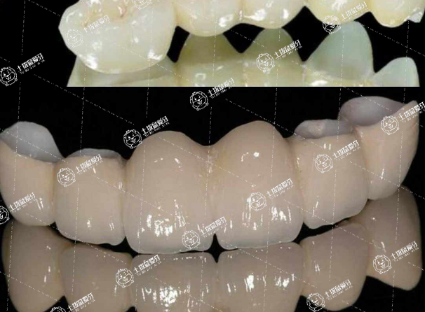 全瓷牙材質(zhì)大概有幾種