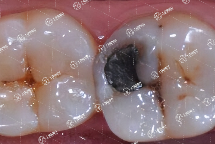 全瓷牙效果怎么樣