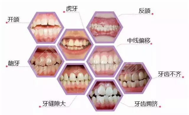 牙齒矯正