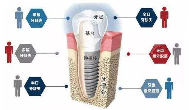 種植牙和其他義齒的壽命那個長