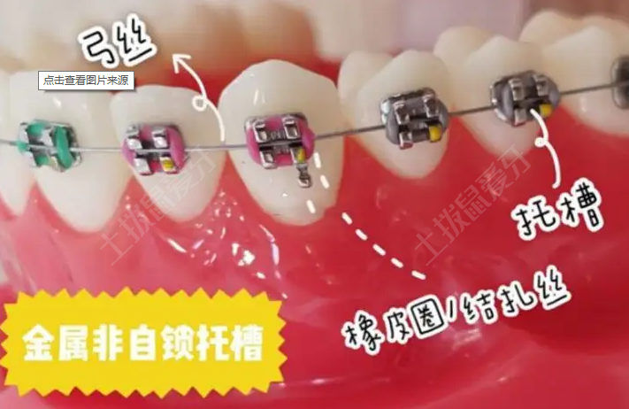 普通金屬托槽矯正