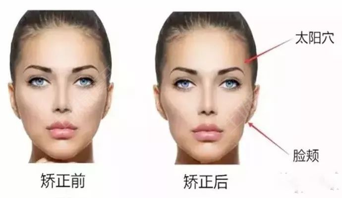 牙套臉