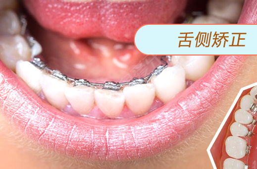 舌側(cè)矯正