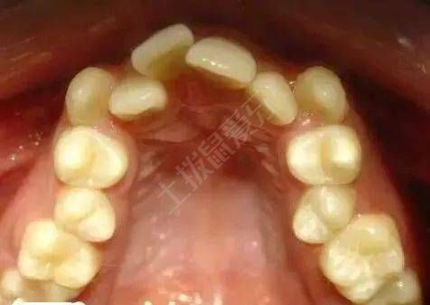 矯正牙齒擁擠度怎么算