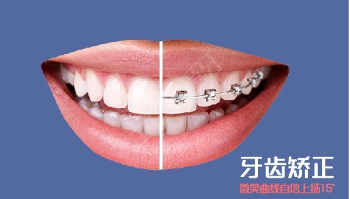 矯正牙齒戴牙套會痛嗎