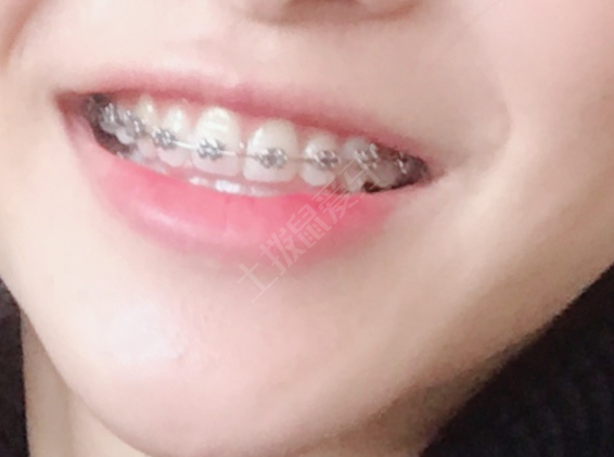 陶瓷矯正是什么