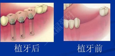 牙齒做種植牙價(jià)格多少